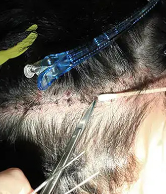 Stitch removal