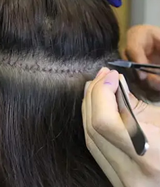 Stitch removal