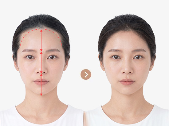 Angular forehead