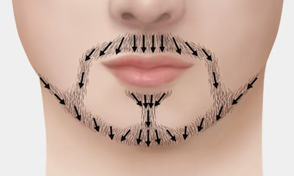 Implantation that follows beard growth direction