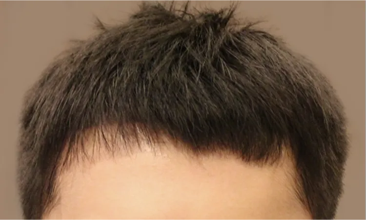Day after FUE surgery (front)