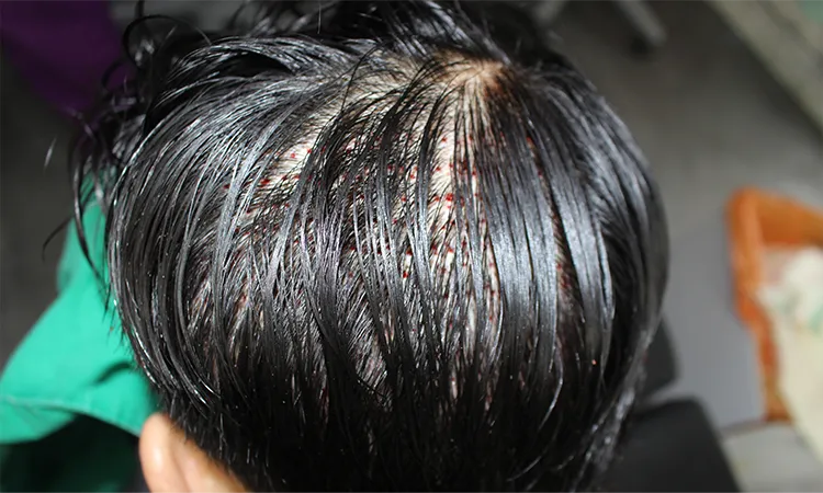 Right after Hide Cut surgery