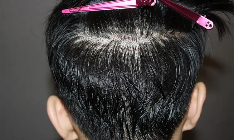1 day after Hide Cut surgery
