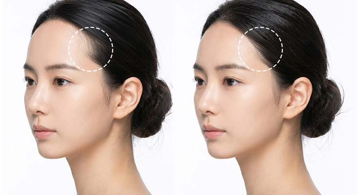 MOJELIM hairline correction designed with the side profile in mind