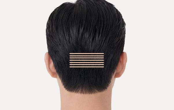 FUE hair transplant
