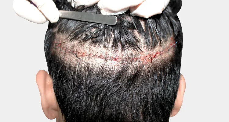Right after FUT surgery