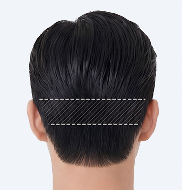 Straight-line incision