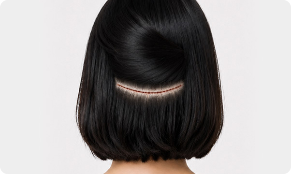 FUT hairline correction