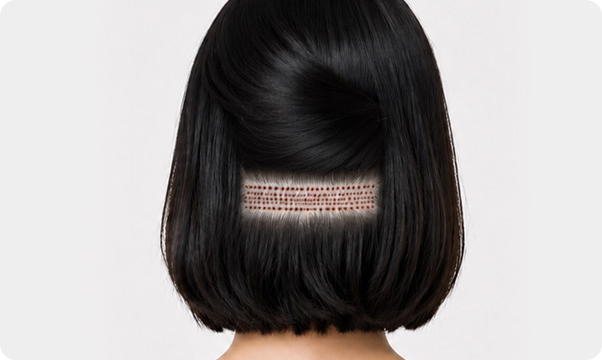 FUE hairline correction
