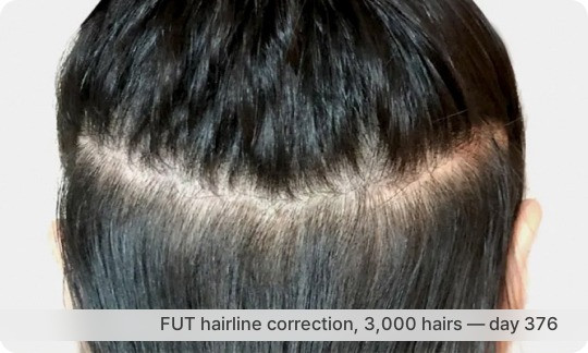 1 year after FUT hairline correction