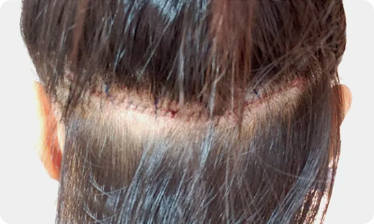 Right after FUT hairline correction