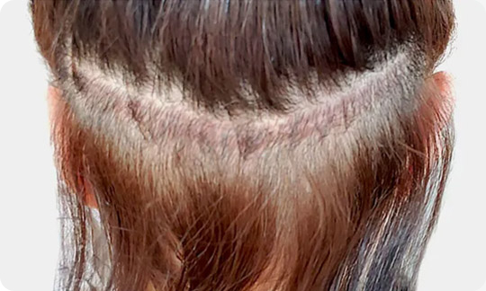 2 weeks after FUT hairline correction