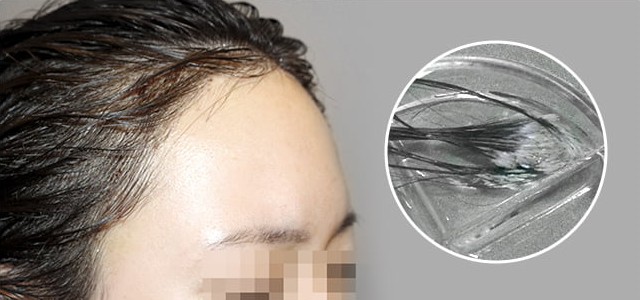 Reference photo of long grafts covering the implant area