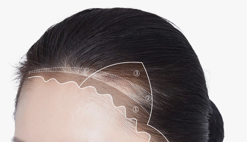 Example of a hairline design that follows the flow of existing hair