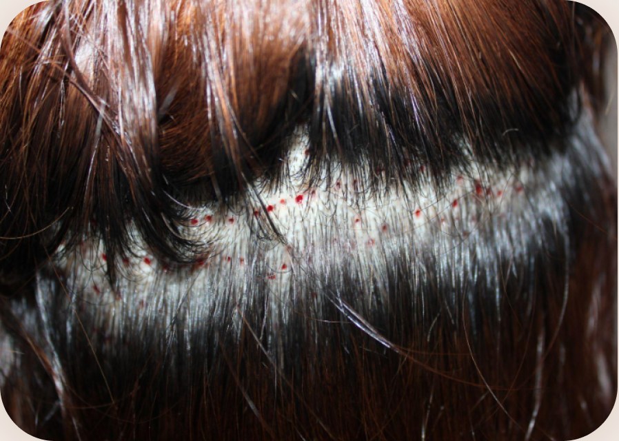 Harvesting follicles without shaving the back of the head