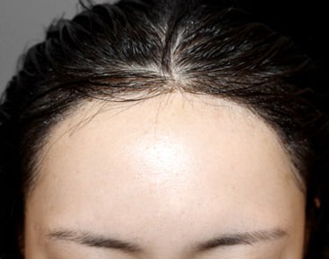 Front view on day 1 after a 3,000-hair long-hair transplant