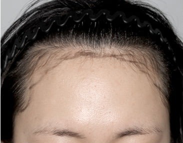 Front · before long-hair transplant