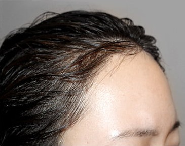 Side 01 · day 1 after a 3,000-hair long-hair transplant