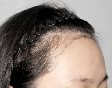 Side 01 · before long-hair transplant