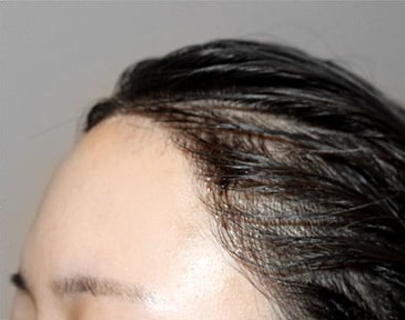 Side 02 · day 1 after a 3,000-hair long-hair transplant