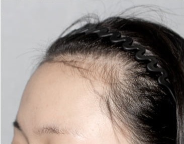 Side 02 · before long-hair transplant