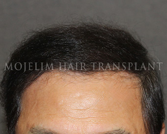 After surgery, 70s, case 3
