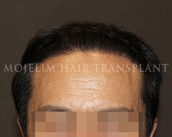 After surgery, 60s, case 2