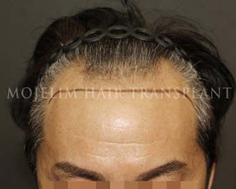 Before surgery, 60s, case 3