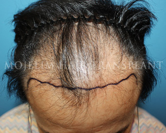 Before surgery, 50s, case 1