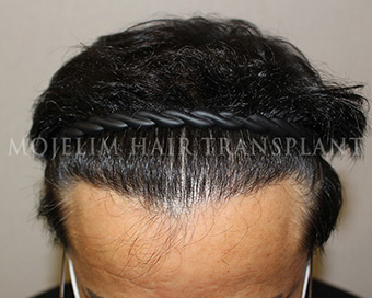 After surgery, 50s, case 1