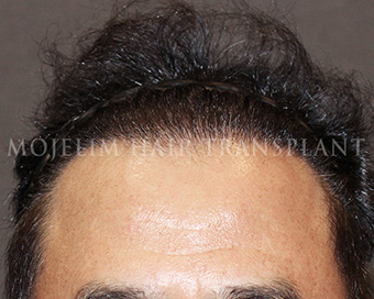 After surgery, 50s, case 3