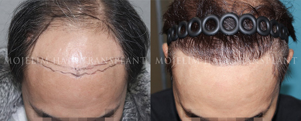Surgical result 1