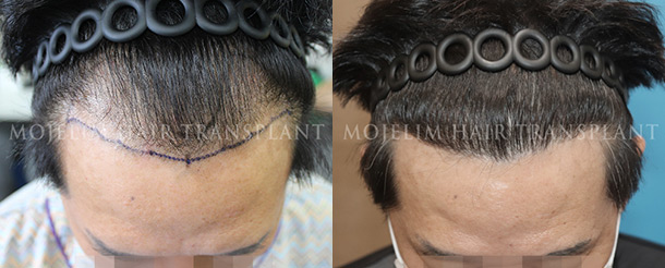 Surgical result 2