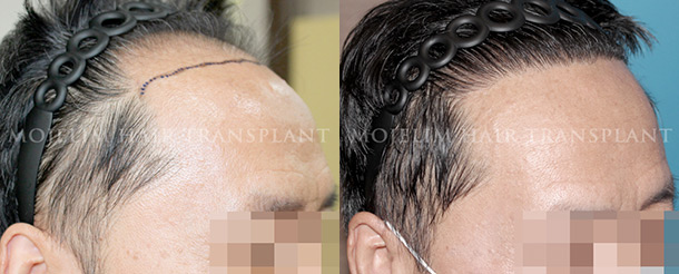 Surgical result 3