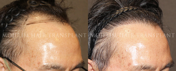 Surgical result 4