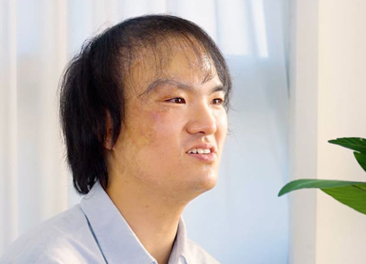 MOJELIM scar hair transplant
