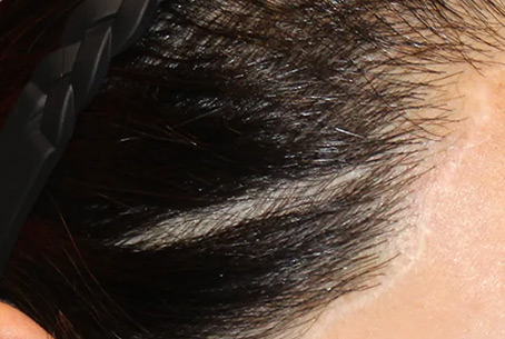 Scars from cosmetic surgery