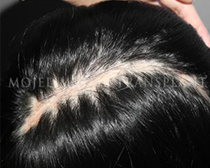 Case 1. Scalp scar after brain surgery