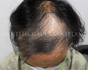 Case 2. Burn scar (scalp)