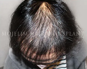 Case 2. Burn scar (scalp)