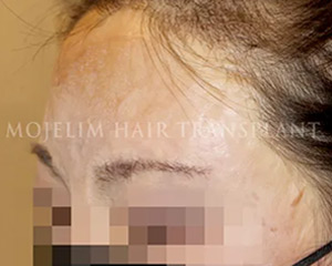 Case 3. Burn scar (eyebrow)