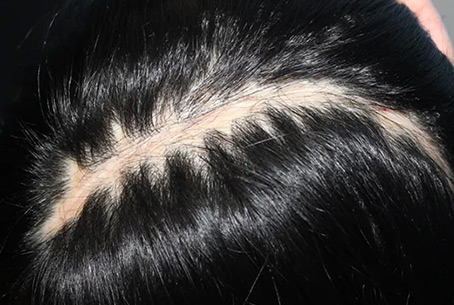 Scars from medical surgery
