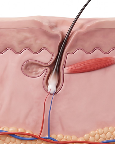 Scar transplant