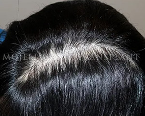 Case 1. Scalp scar after brain surgery