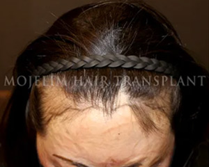 Case 2. Burn scar (scalp)