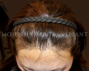 Case 2. Burn scar (scalp)
