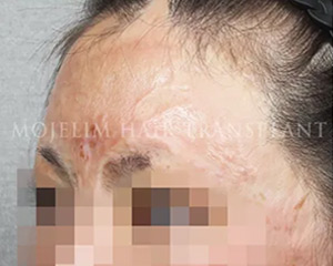 Case 3. Burn scar (eyebrow)
