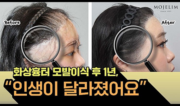 Burn-scar transplant real story