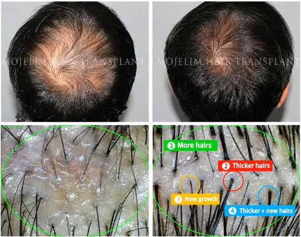 Men — 5 months of MOJELIM hair-loss treatment