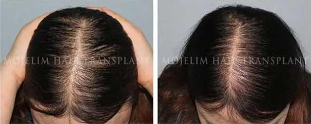 Women — 5 months of MOJELIM hair-loss treatment